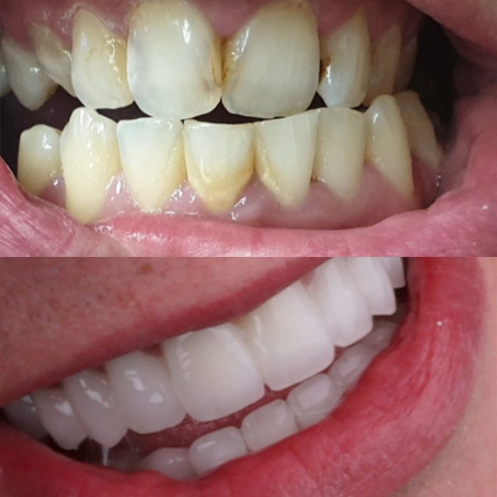 teeth_before_after_1